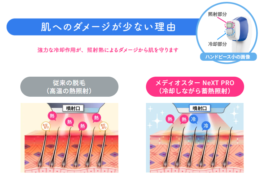 TCB東京医療美容外科の脱毛機の説明画像