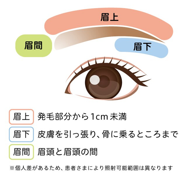 アリシアクリニック眉毛付近の照射範囲